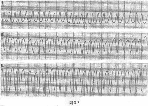 心室颤动 参考答案: b 查看答案解析进入焚题库 不定项选择题第2题