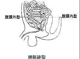 鉴别腹膜内型和腹膜外型的膀胱破裂最好的方法是