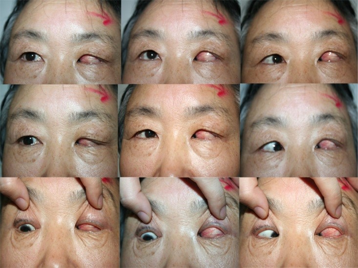 患者女性65岁6年前开始左眼内斜视伴下斜