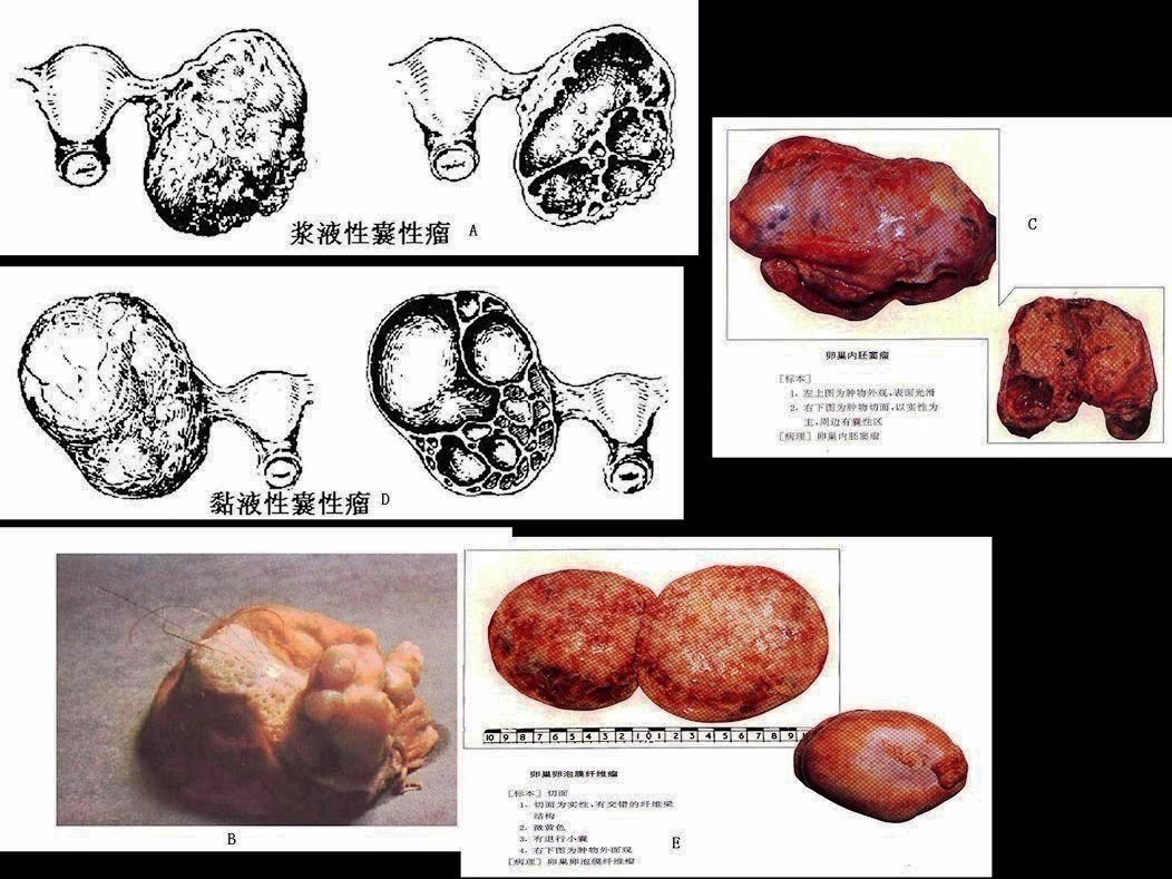 浆液性囊腺瘤 b.成熟畸胎瘤 c.内胚窦瘤 d.黏液性囊腺瘤 e.