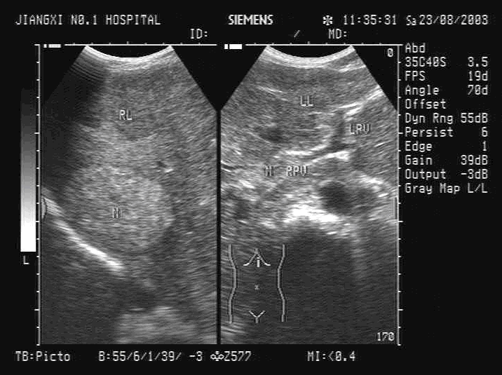 某患者肝脏超声检查如图最可能的诊断是