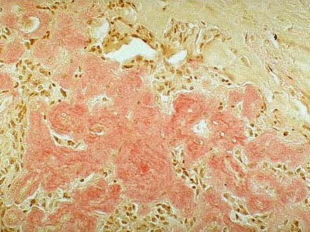 图1为甲状腺髓样癌的镜下观图2为该肿瘤刚果红染色镜下观