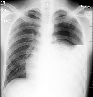 左侧液气胸 d左侧肺不张 e左侧气胸 参考答案: c