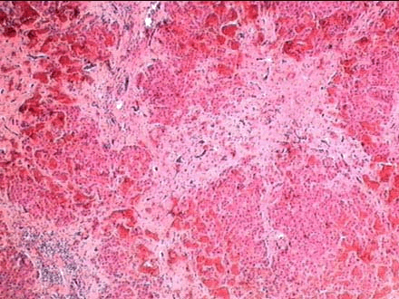 慢性肝淤血病理切片图片
