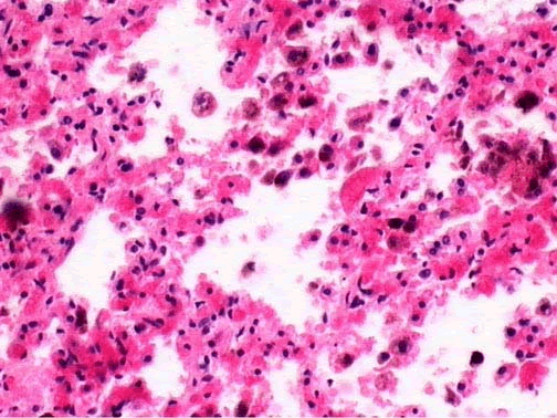 肺淤血切片图图片