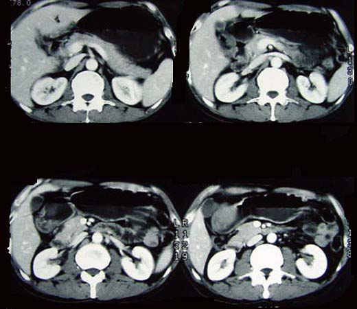 女性42岁腹痛黑便1周ct扫描见胃窦部圆形块影