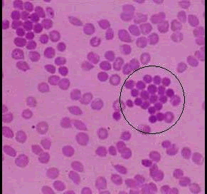 如图所示的异常红细胞增多可见于